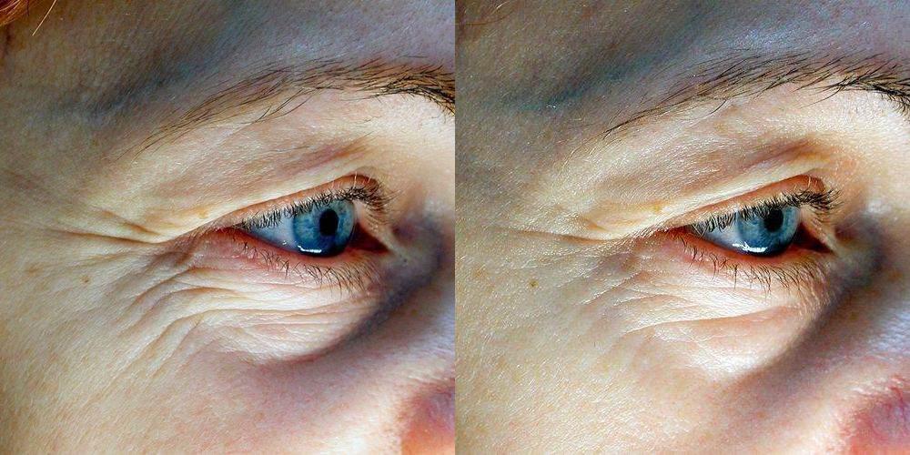Matrixyl 3000: Peptida biomimetică care reactivează tinerețea pielii